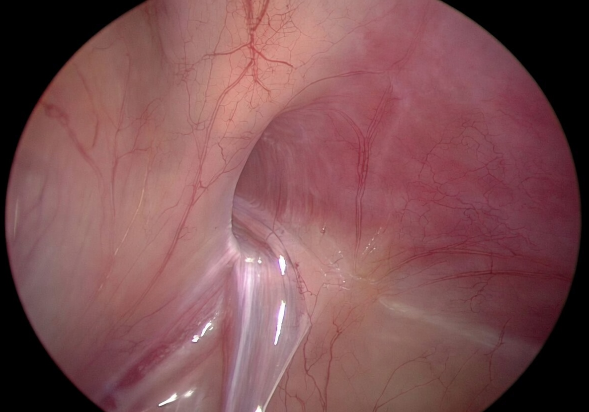 Visión laparoscópica de conducto peritoneo vaginal permeable