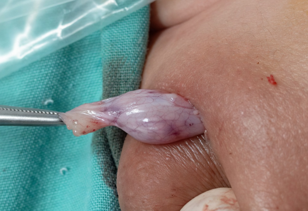 Descenso quirúrgico de testículo al escroto - orquidopexia