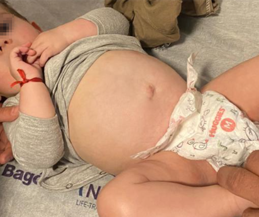 Evolución favorable de hernia umbilical con manejo conservador