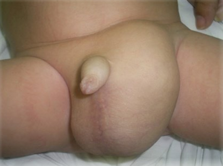 Hernia inguinal grande en bebé - imagen clínica educativa