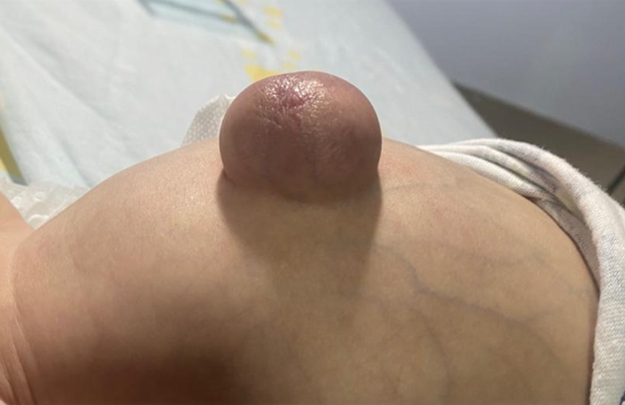 Hernia umbilical grande en lactante