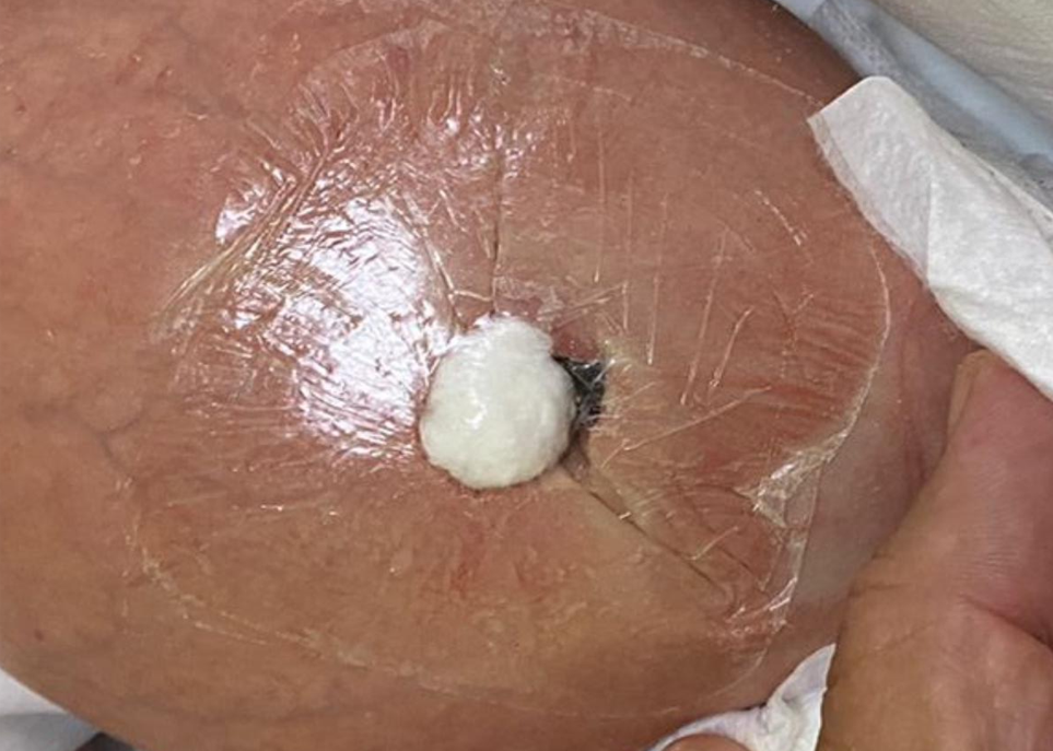 Parche reductor para hernia umbilical en lactante