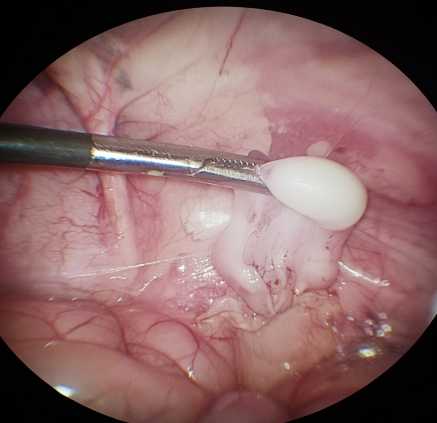 Testículo intraabdominal en niño - imagen quirúrgica educativa