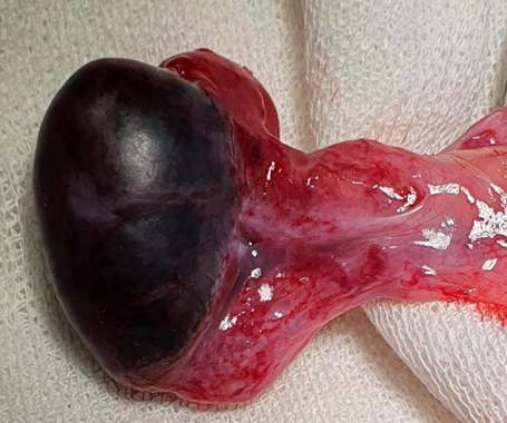 Necrosis testicular por torsión testicular de evolución prolongada