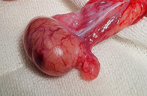 Testículo recuperado tras cirugía temprana de torsión testicular
