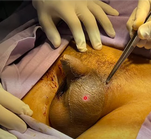 Elevación e inflamación típica en torsión testicular aguda